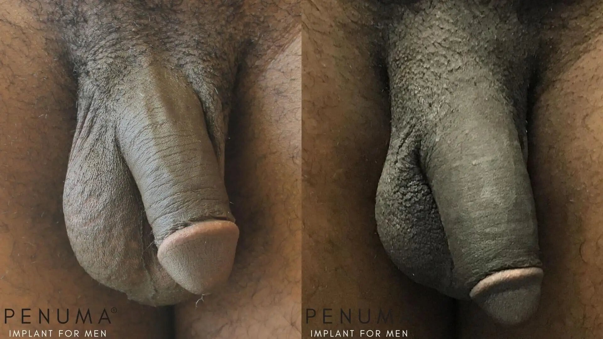 penuma-penile-enhancement8