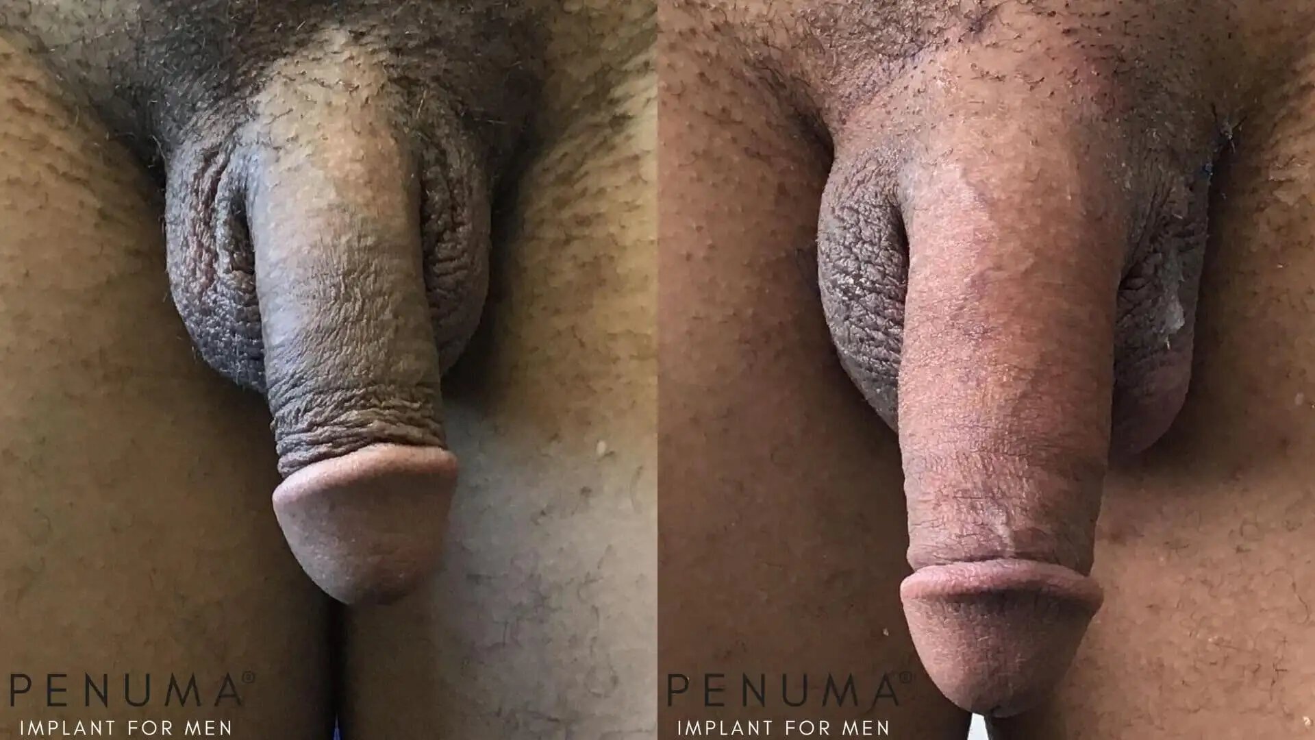 penuma-penile-enhancement9